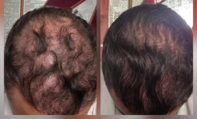 DERMA STAMP RESULTAT